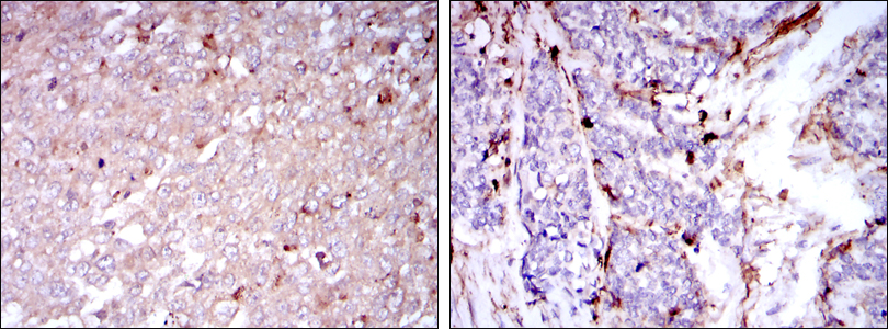 Figure 1: Immunohistochemical analysis of paraffin-embedded human breast cancer tissues (left) and human esophageal cancer tissues (right) using CD133 mouse mAb with DAB staining.
