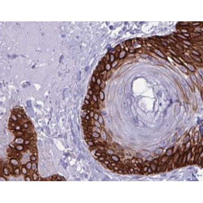 AF0192 at 1/500 staining human colon cancer tissue sections by IHC-P. The tissue was formaldehyde fixed and a heat mediated antigen retrieval step in citrate buffer was performed.