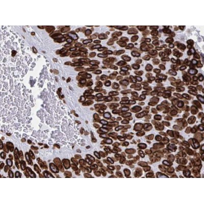 AF5161 at 1/100 staining human Pancreas cancer tissues sections by IHC-P. The tissue was formaldehyde fixed and a heat mediated antigen retrieval step in citrate buffer was performed. The tissue was then blocked and incubated with the antibody for 1.5 hou