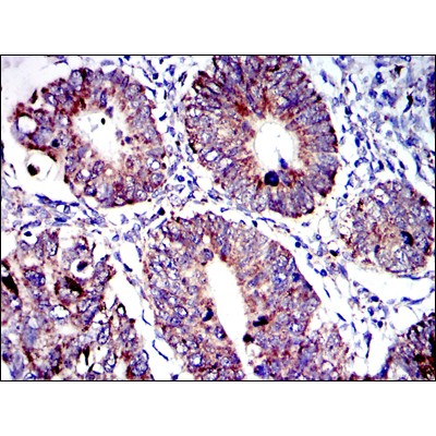 Immunohistochemical analysis of paraffin-embedded human rectum cancer tissues using AIF mouse mAb with DAB staining. 