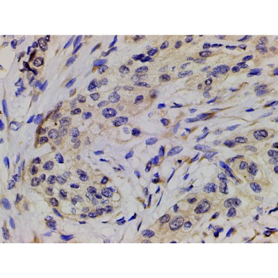 AF3241 at 1/200 staining human esophageal carcinoma tissue sections by IHC-P. The tissue was formaldehyde fixed and a heat mediated antigen retrieval step in citrate buffer was performed.
