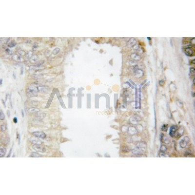 AF6139 at 1/100 dilution staining bcl2 in human breast carcinoma by Immunohistochemistry using paraffin-embedded tissue
