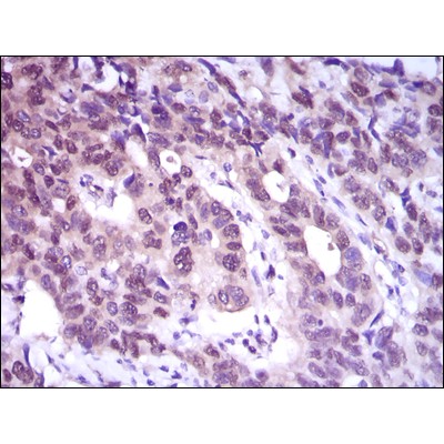 Immunohistochemical analysis of paraffin-embedded esophageal cancer tissues using ACLY mouse mAb with DAB staining.