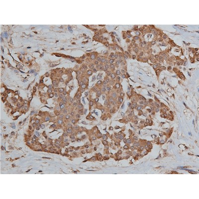 AF6126 at 1/50 staining human liver cancer tissue sections by IHC-P. The tissue was formaldehyde fixed and a heat mediated antigen retrieval step in citrate buffer was performed.
