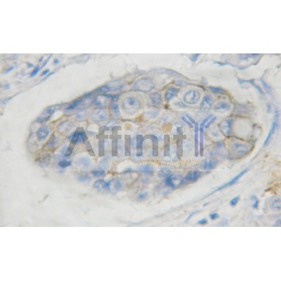 AF3152 at 1/100 staining human breast carcinoma tissues sections by IHC-P. The tissue was formaldehyde fixed and a heat mediated antigen retrieval step in citrate buffer was performed. The tissue was then blocked and incubated with the antibody for 1.5 ho