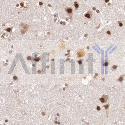 AF6261 at 1/100 staining human brain cancer tissue sections by IHC-P. The tissue was formaldehyde fixed and a heat mediated antigen retrieval step in citrate buffer was performed.