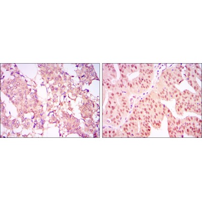 Figure 2: Immunohistochemical analysis of paraffin-embedded breast cancer tissues (left) and ovarian cancer tissues (right) using CARM1 mouse mAb with DAB staining.