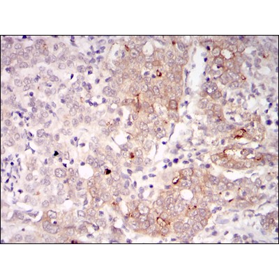 Figure 3: Immunohistochemical analysis of paraffin-embedded human cervical cancer tissues using BLNK mouse mAb with DAB staining.?