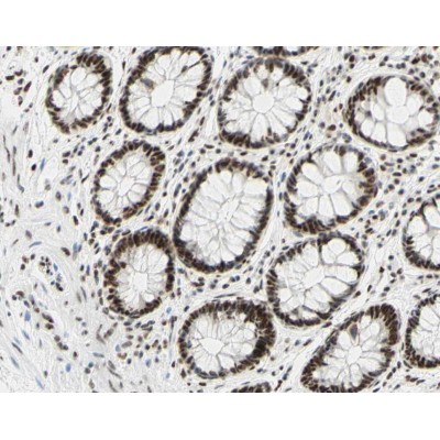 AF3095 at 1/200 staining human colon cancer tissue sections by IHC-P. The tissue was formaldehyde fixed and a heat mediated antigen retrieval step in citrate buffer was performed.