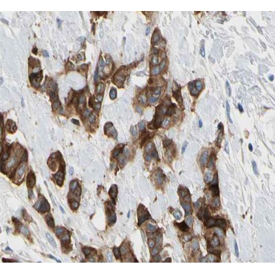 AF0195 at 1/200 staining human breast carcinoma tissue sections by IHC-P. The tissue was formaldehyde fixed and a heat mediated antigen retrieval step in citrate buffer was performed.