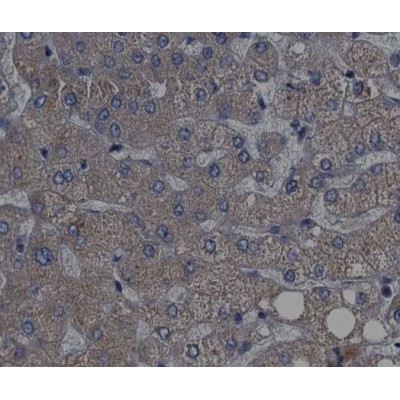 AF3228 at 1/200 staining human liver cancer tissue sections by IHC-P. The tissue was formaldehyde fixed and a heat mediated antigen retrieval step in citrate buffer was performed.
