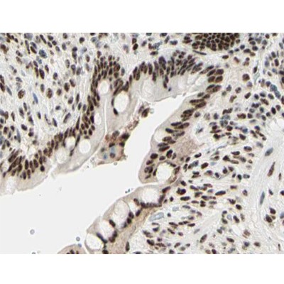 AF3358 at 1/200 staining human colon cancer tissue sections by IHC-P. The tissue was formaldehyde fixed and a heat mediated antigen retrieval step in citrate buffer was performed.