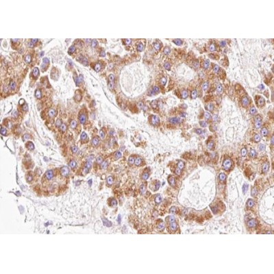 AF0908 at 1/100 staining human lung carcinoma tissue sections by IHC-P. The tissue was formaldehyde fixed and a heat mediated antigen retrieval step in citrate buffer was performed.