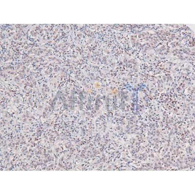 AF8162 at 1/200 staining Human lung cancer tissue sections by IHC-P. The tissue was formaldehyde fixed and a heat mediated antigen retrieval step in citrate buffer was performed.
