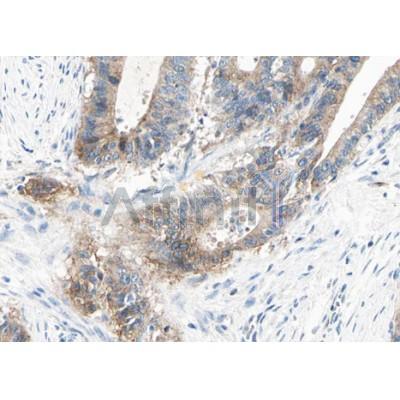 AF5248 at 1/100 staining human Liver cancer tissue sections by IHC-P. The tissue was formaldehyde fixed and a heat mediated antigen retrieval step in citrate buffer was performed.
