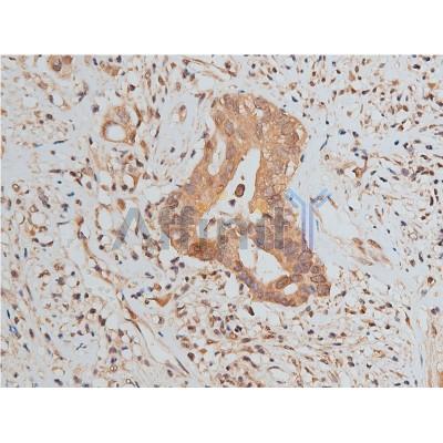 AF7021 at 1/50 staining human colon cancer tissue sections by IHC-P. The tissue was formaldehyde fixed and a heat mediated antigen retrieval step in citrate buffer was performed.