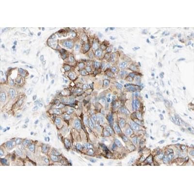 AF4039 at 1/100 staining human lung carcinoma tissue sections by IHC-P. The tissue was formaldehyde fixed and a heat mediated antigen retrieval step in citrate buffer was performed.