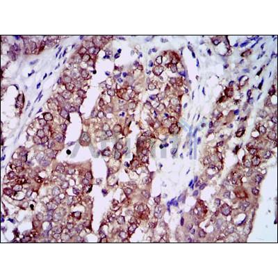  Immunohistochemical analysis of paraffin-embedded bladder cancer tissues using HSP90AA1 mouse mAb with DAB staining.\