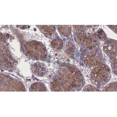 DF7504 at 1/100 staining Human liver cancer tissue by IHC-P. The sample was formaldehyde fixed and a heat mediated antigen retrieval step in citrate buffer was performed. The sample was then blocked and incubated with the antibody for 1.5 hours at 22C. 