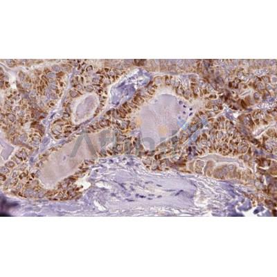 DF12509 at 1/100 staining Human thyroid cancer tissue by IHC-P.The sample was formaldehyde fixed and a heat mediated antigen retrieval step in citrate buffer was performed.The sample wasThen blocked and incubated withThe antibody for 1.5 hours at 22C. 