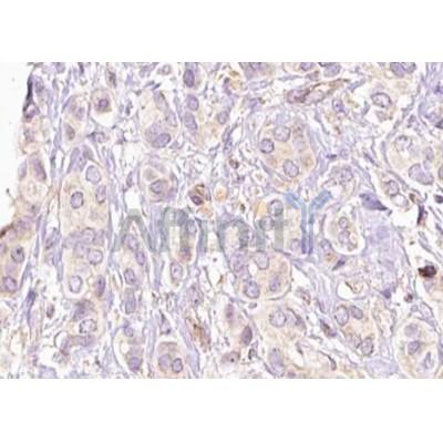AF6222 at 1/100 staining Human breast cancer tissue by IHC-P. The sample was formaldehyde fixed and a heat mediated antigen retrieval step in citrate buffer was performed. The sample was then blocked and incubated with the antibody for 1.5 hours at 22C. 