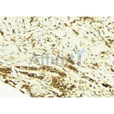AF6200 at 1/100 staining Human breast cancer tissue by IHC-P. The sample was formaldehyde fixed and a heat mediated antigen retrieval step in citrate buffer was performed. The sample was then blocked and incubated with the antibody for 1.5 hours at 22C. 