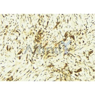 AF6300 at 1/100 staining Human breast cancer tissue by IHC-P. The sample was formaldehyde fixed and a heat mediated antigen retrieval step in citrate buffer was performed. The sample was then blocked and incubated with the antibody for 1.5 hours at 22C. 