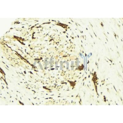 AF6302 at 1/100 staining Human breast cancer tissue by IHC-P.The sample was formaldehyde fixed and a heat mediated antigen retrieval step in citrate buffer was performed.The sample was then blocked and incubated with the antibody for 1.5 hours at 22C.
