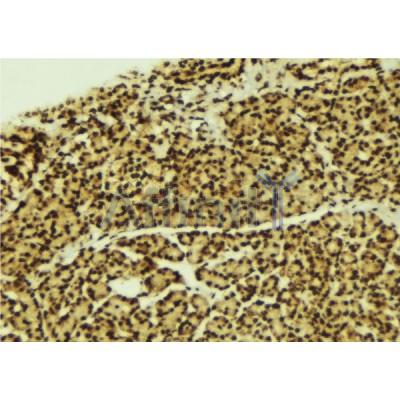 AF6333 at 1/100 staining Human breast cancer tissue by IHC-P.The sample was formaldehyde fixed and a heat mediated antigen retrieval step in citrate buffer was performed.The sample was then blocked and incubated with the antibody for 1.5 hours at 22C.