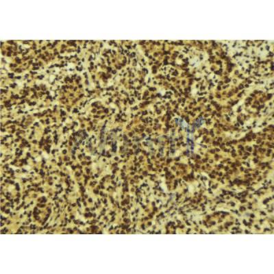 AF6373 at 1/100 staining Human breast cancer tissue by IHC-P.The sample was formaldehyde fixed and a heat mediated antigen retrieval step in citrate buffer was performed.The sample was then blocked and incubated with the antibody for 1.5 hours at 22C.