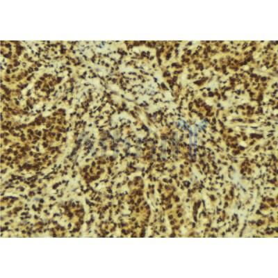 AF6387 at 1/100 staining Human breast cancer tissue by IHC-P. The sample was formaldehyde fixed and a heat mediated antigen retrieval step in citrate buffer was performed. The sample was then blocked and incubated with the antibody for 1.5 hours at 22C. 