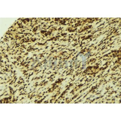 AF6441 at 1/100 staining Human breast cancer tissue by IHC-P.The sample was formaldehyde fixed and a heat mediated antigen retrieval step in citrate buffer was performed.The sample was then blocked and incubated with the antibody for 1.5 hours at 22C.