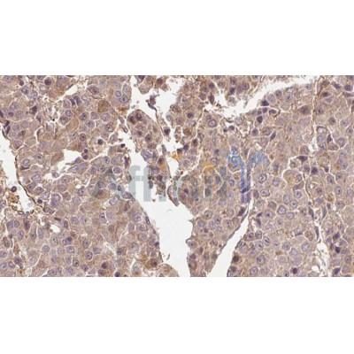 DF3497 at 1/100 staining Human liver cancer tissue by IHC-P.The sample was formaldehyde fixed and a heat mediated antigen retrieval step in citrate buffer was performed.The sample was then blocked and incubated with the antibody for 1.5 hours at 22C.