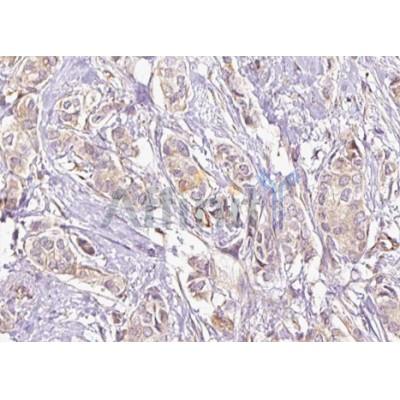 DF3814 at 1/100 staining Human breast cancer tissue by IHC-P.The sample was formaldehyde fixed and a heat mediated antigen retrieval step in citrate buffer was performed.The sample was then blocked and incubated with the antibody for 1.5 hours at 22C.