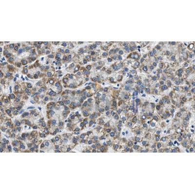 AF5145 at 1/100 staining Human liver cancer tissue by IHC-P. The sample was formaldehyde fixed and a heat mediated antigen retrieval step in citrate buffer was performed. The sample was then blocked and incubated with the antibody for 1.5 hours at 22C. 