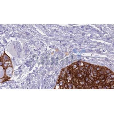 AF5364 at 1/100 staining Human urothelial cancer tissue by IHC-P.The sample was formaldehyde fixed and a heat mediated antigen retrieval step in citrate buffer was performed.The sample was then blocked and incubated with the antibody for 1.5 hours at 22C.