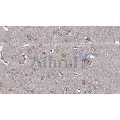 DF6292 at 1/100 staining Human brain cancer tissue by IHC-P.The sample was formaldehyde fixed and a heat mediated antigen retrieval step in citrate buffer was performed.The sample was then blocked and incubated with the antibody for 1.5 hours at 22C.