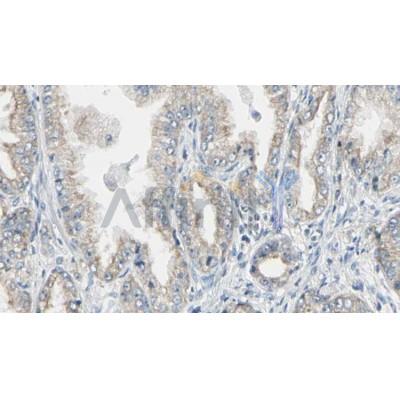 DF6380 at 1/100 staining Human prostate tissue by IHC-P.The sample was formaldehyde fixed and a heat mediated antigen retrieval step in citrate buffer was performed.The sample was then blocked and incubated with the antibody for 1.5 hours at 22C.