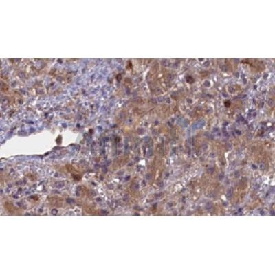 DF6673 at 1/100 staining Human liver cancer tissue by IHC-P.The sample was formaldehyde fixed and a heat mediated antigen retrieval step in citrate buffer was performed.The sample was then blocked and incubated with the antibody for 1.5 hours at 22C.
