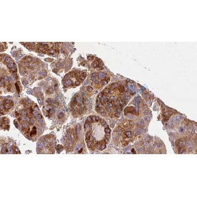 DF7067 at 1/100 staining Human liver cancer tissue by IHC-P. The sample was formaldehyde fixed and a heat mediated antigen retrieval step in citrate buffer was performed. The sample was then blocked and incubated with the antibody for 1.5 hours at 22C. 