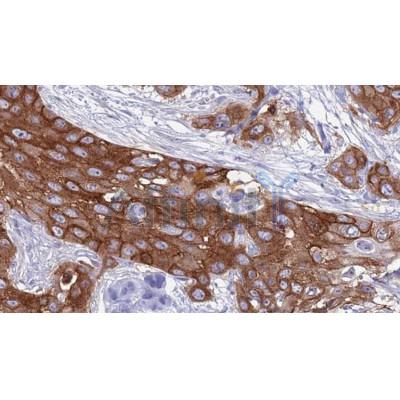 DF7149 at 1/100 staining Human Head and neck cancer tissue by IHC-P. The sample was formaldehyde fixed and a heat mediated antigen retrieval step in citrate buffer was performed.