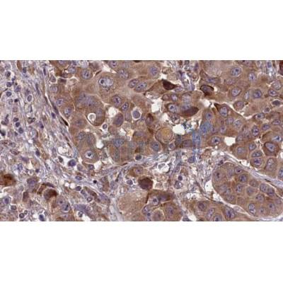 DF7437 at 1/100 staining Human liver cancer tissue by IHC-P.The sample was formaldehyde fixed and a heat mediated antigen retrieval step in citrate buffer was performed.The sample was then blocked and incubated with the antibody for 1.5 hours at 22C.
