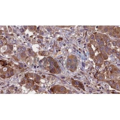 DF7451 at 1/100 staining Human liver cancer tissue by IHC-P.The sample was formaldehyde fixed and a heat mediated antigen retrieval step in citrate buffer was performed.The sample was then blocked and incubated with the antibody for 1.5 hours at 22C.