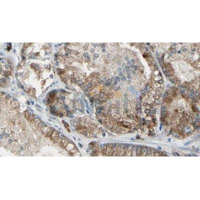 AF7018 at 1/100 staining Human prostate tissue by IHC-P. The sample was formaldehyde fixed and a heat mediated antigen retrieval step in citrate buffer was performed. The sample was then blocked and incubated with the antibody for 1.5 hours at 22C. 