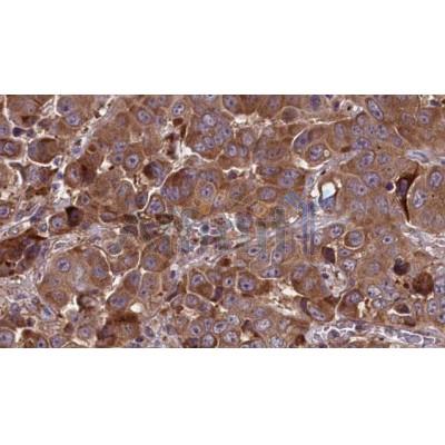 DF2707 at 1/100 staining Human liver cancer tissue by IHC-P.The sample was formaldehyde fixed and a heat mediated antigen retrieval step in citrate buffer was performed.The sample was then blocked and incubated with the antibody for 1.5 hours at 22C.