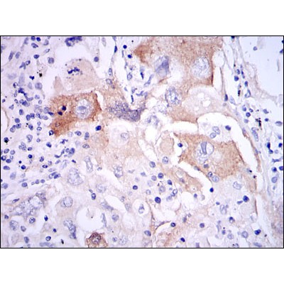 IL1B Antibody - Immunohistochemical analysis of paraffin-embedded lung cancer tissues using IL1B mouse mAb with DAB staining.