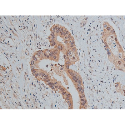 Phospho-Src (Tyr527)[Tyr530] Antibody - AF3161 at 1/50 staining human colon carcinoma tissue sections by IHC-P.