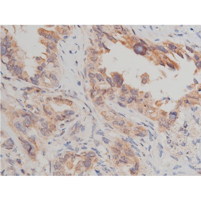 Phospho-mTOR (Ser2448) Antibody - AF3308 at 1/50 staining human lung cancer tissue sections by IHC-P.