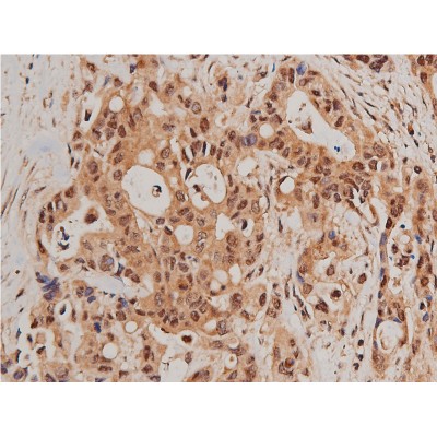 Phospho-FOXO1A (Ser319) Antibody - AF3418 at 1/200 staining human colon cancer tissue sections by IHC-P.