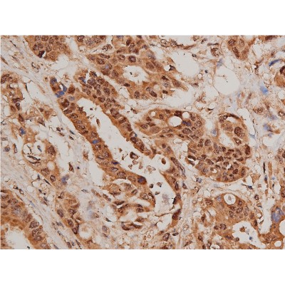Phospho-FOXO1A (Ser319) Antibody - AF3418 at 1/50 staining human colon cancer tissue sections by IHC-P.